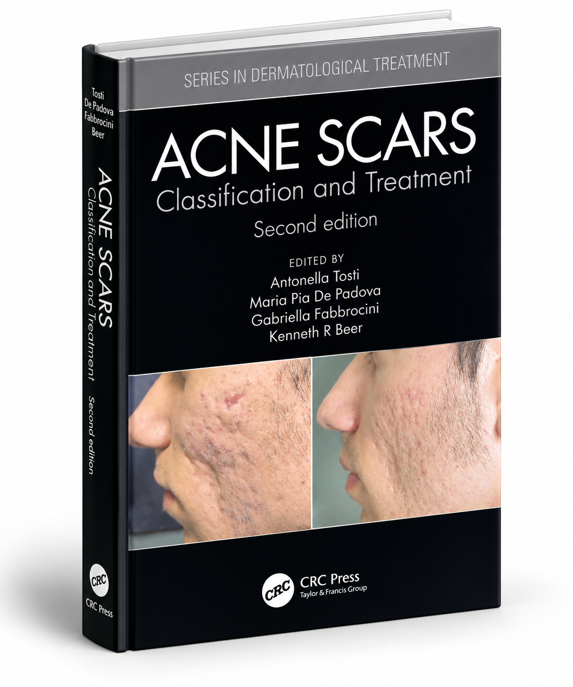 Acne Scars: Classification and Treatment, Second Edition