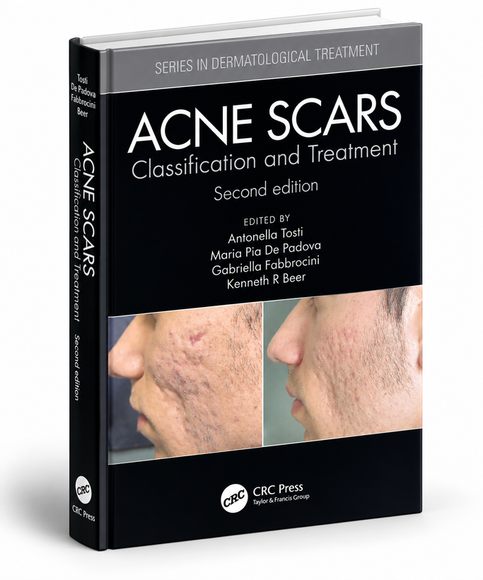 Acne Scars: Classification and Treatment, Second Edition