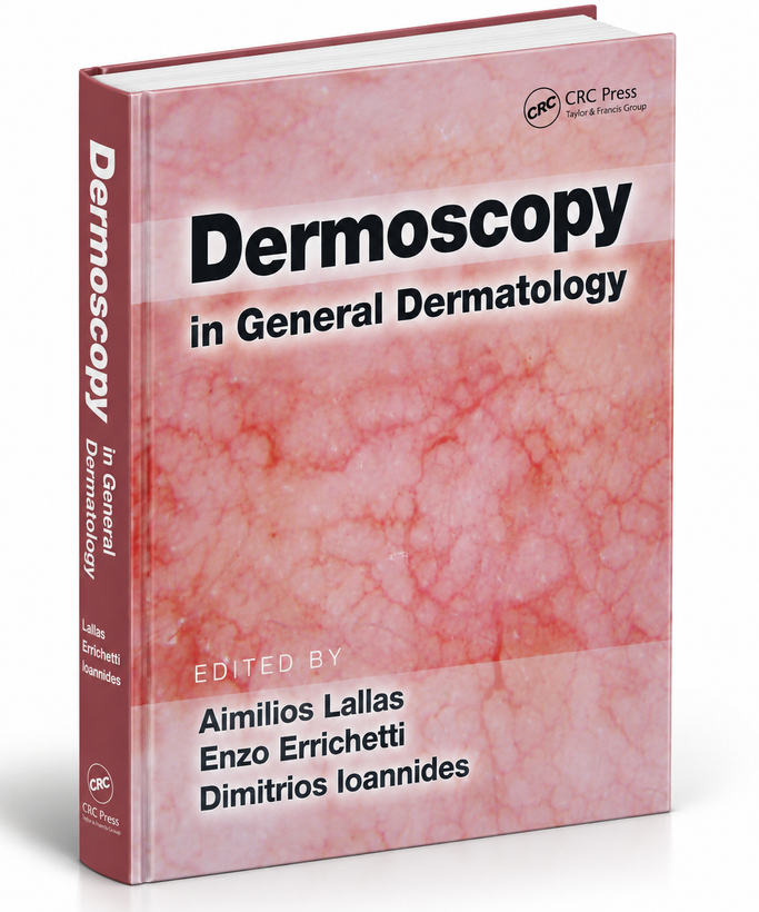 Dermoscopy in General Dermatology