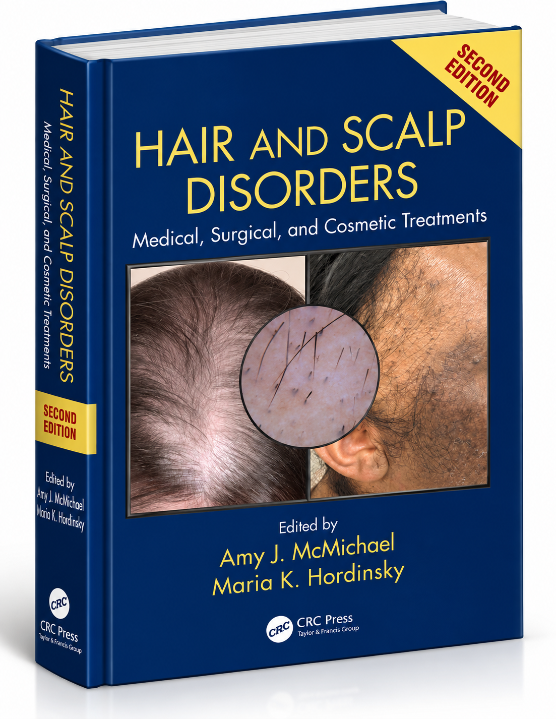 Hair and Scalp Disorders: Medical, Surgical, and Cosmetic Treatments