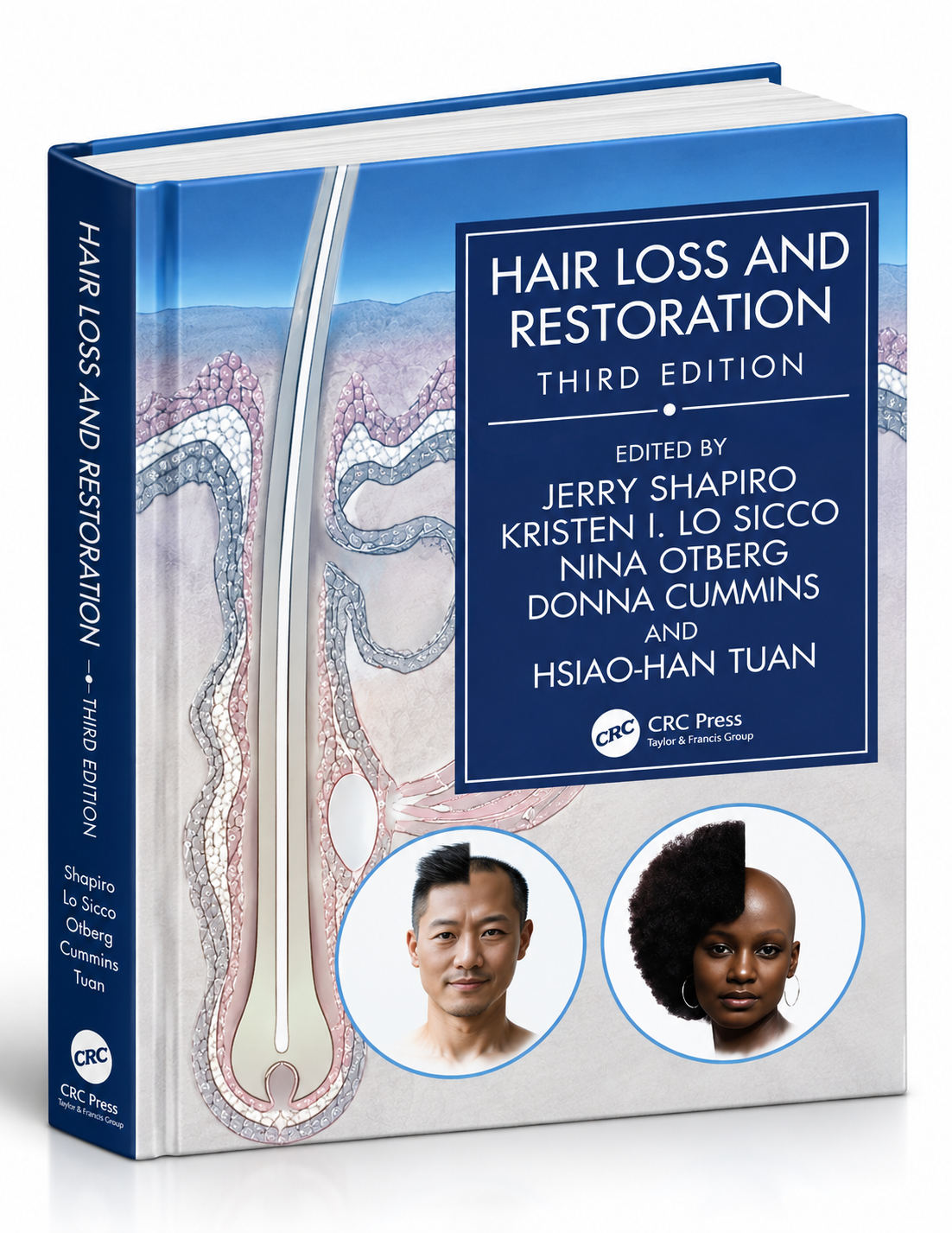 Hair Loss and Restoration – 3rd Edition