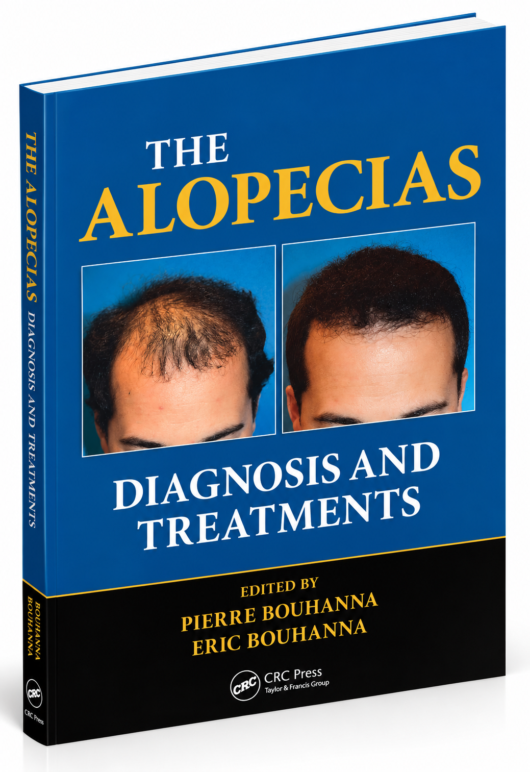 The Alopecias: Diagnosis and Treatments